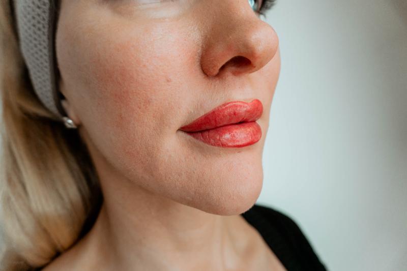 Bb lips / Bb kiss mesoterapi