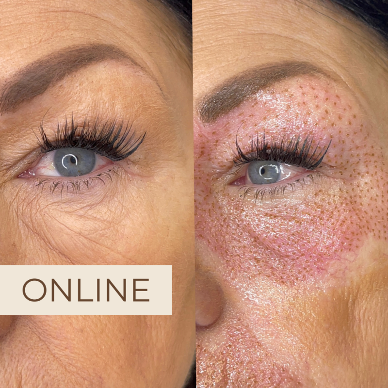 Plasma pen onlineutbildning