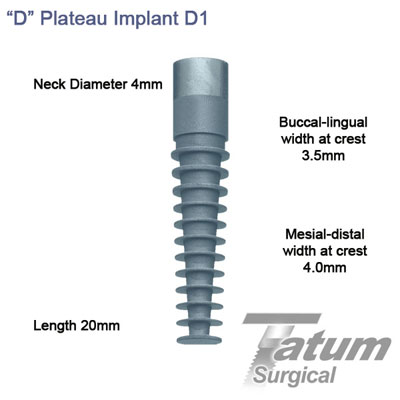 D Plateau Implants D1 4.0x20mm, Regular mesial-distal 4mm