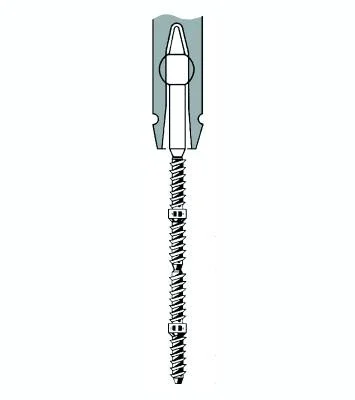 TMS Link plus Minim 2/1 Titan 24st