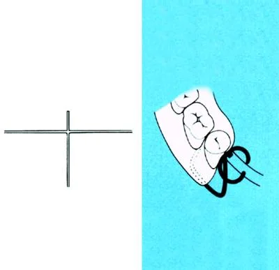 TK-klammer 1,0mm 100st