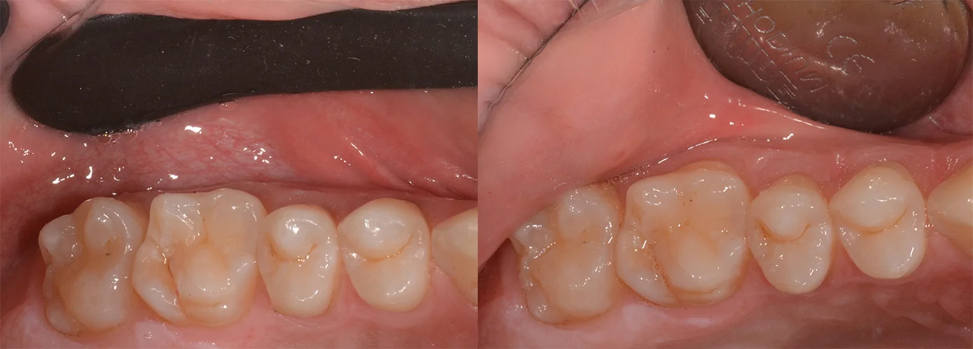 Photo-CAD full set, 3 pcs (2 UP and 1 LO)