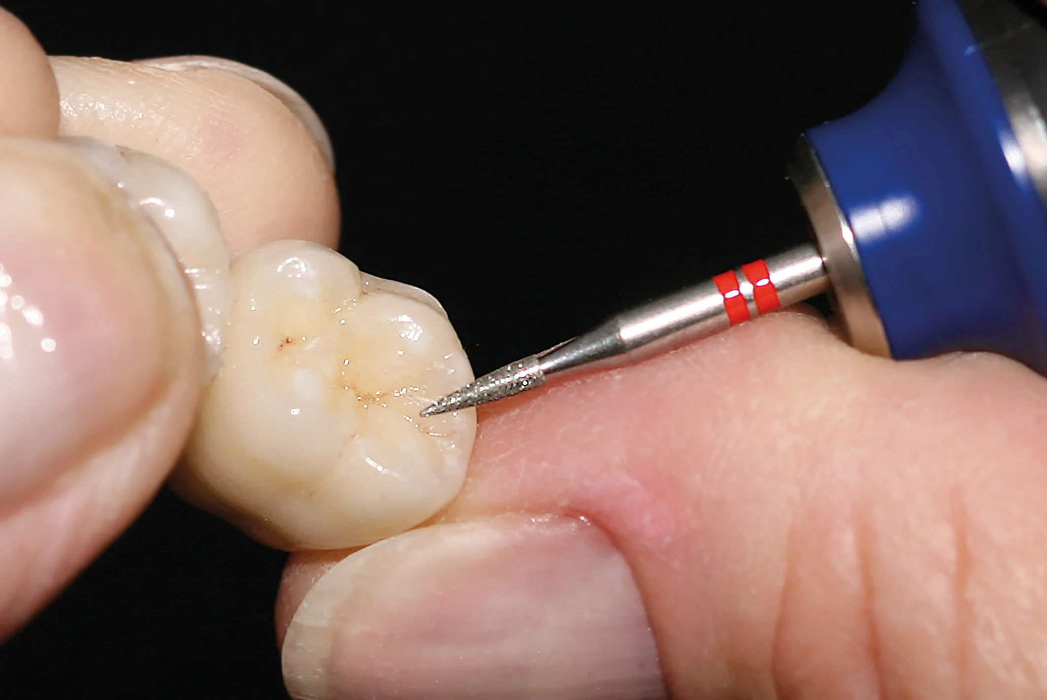 NTI - Diamantfräs standard, (nålspets)- 859-018F-HP- 5-pack