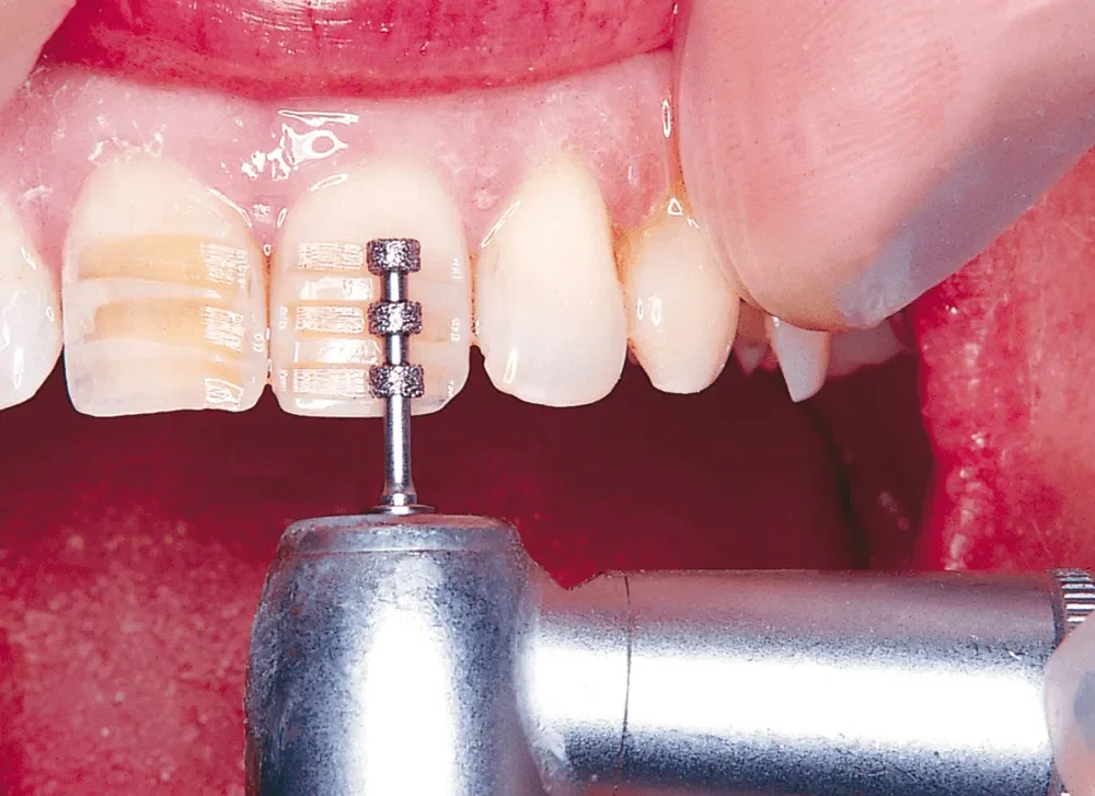 NTI - Depth Marker -  834RL-027M-FG -  5-pack