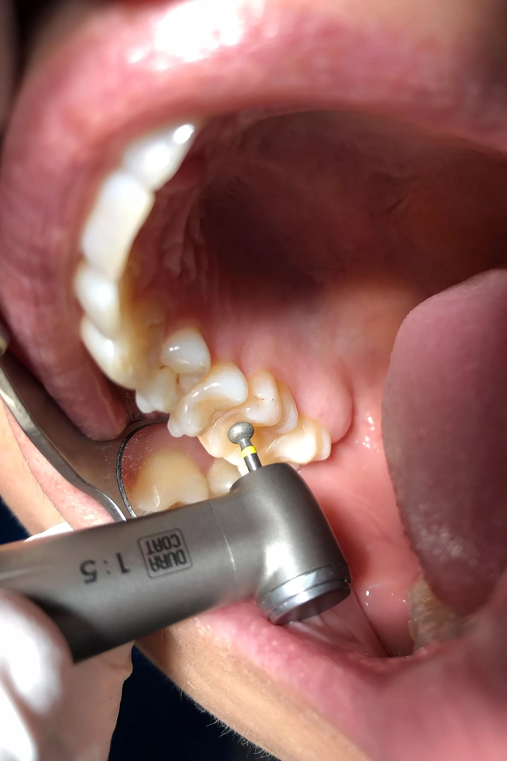 NTI - LazyBur (röd-fin) -  986-041F-FG -  5-pack