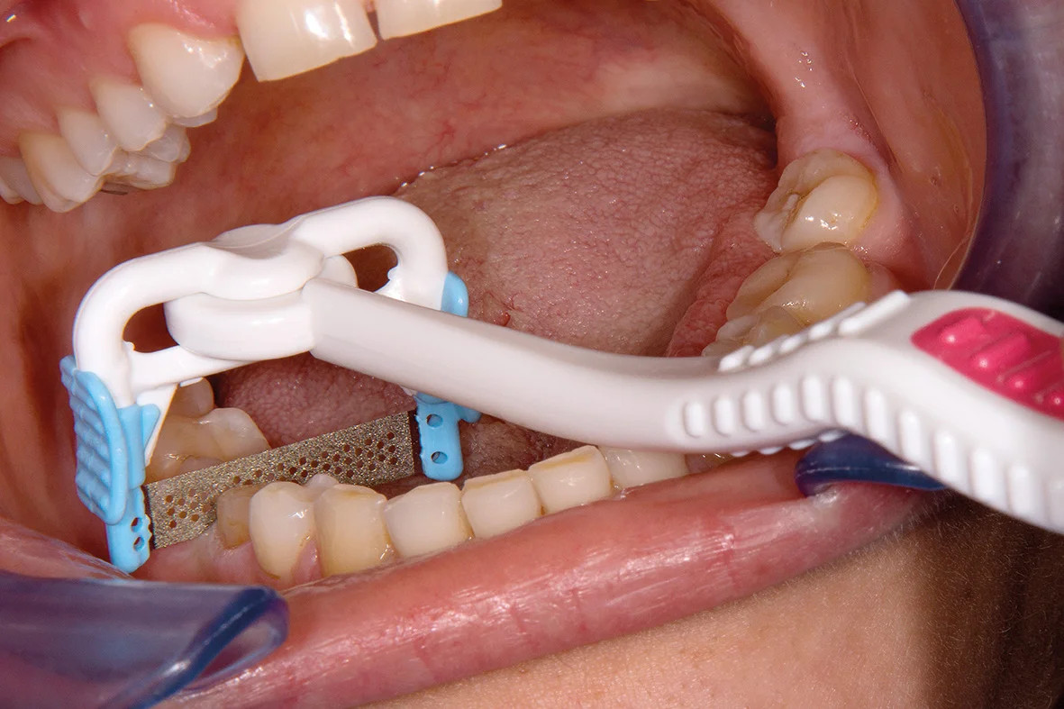 NTI - ProxyStrip  -  FS5-MKP -  10-pack