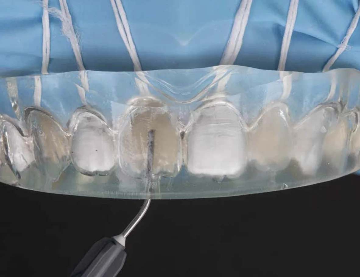 EXACLEAR cartridges 2x 48ml (51g)