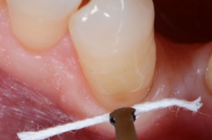 Pascal PickPack Forte pincett+trådpackare