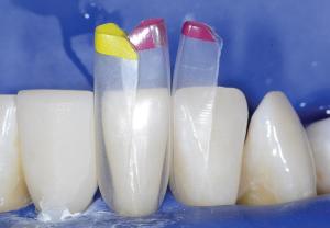 BioClear Black Triangle kit