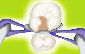 Contact Wedge 85 st/frp