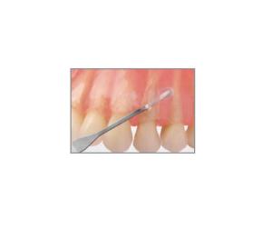 Mikroskalpell för tunnelering #003 Devemed 10 st/frp