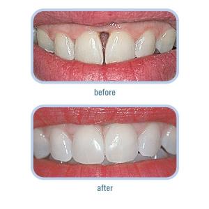 Renamel Gingafill 3,5 g