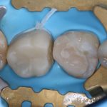 Hallerklammer, dubbel