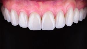 Renamel Microfill, kapslar, 20 st