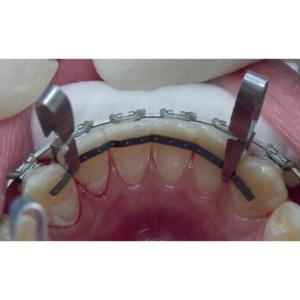 Strauss klämmor för retainer, 3st