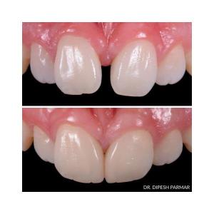 Renamel NANO PLUS, kapslar, 10 st