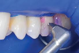 Blaster Disclosing Solution/Biofilminfärgning 59 ml