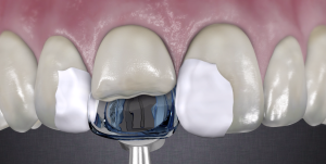 Paladex palatinala matriser 48 matriser+instrument