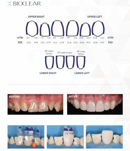 Bioclear Tooth & Surface Specific matriser, refiller 25 st