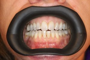 VisionButler läpp- och munvinkelhållare,