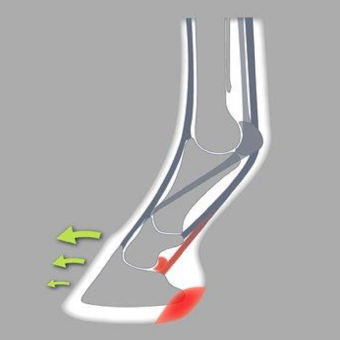 ACR 610 Egg Bar Shoe, Parpris