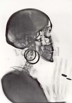 X-Rays, 1964, Postcard