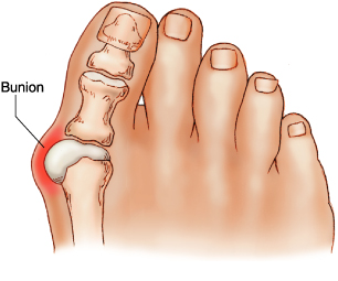Hallux Valgus höger fot - illustration fotknöl och tåled