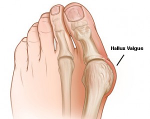 Hallux Valgus vänster fot - illustration växande fotknöl