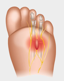 Illustration av Mortons neurom och nervens placering i framfoten