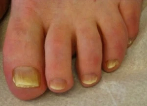 Symtom på nagelsvamp