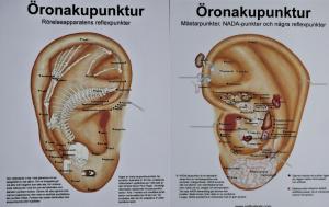 Plansch, öronakupunktur